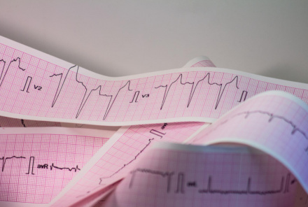 Что такое ЭКГ, как его делают и что она показывает? Какая подготовка?